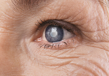 Closeup of an Older Woman With a Cataract in Her Eye