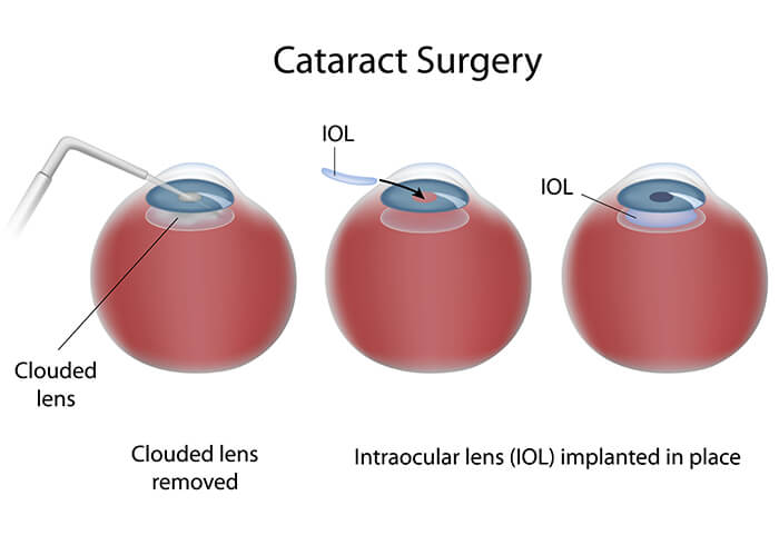 Chart Showing the Steps of Cataract Surgery