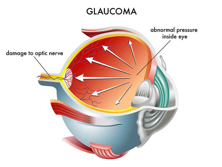Chart Showing How Glaucoma Affects the Eye